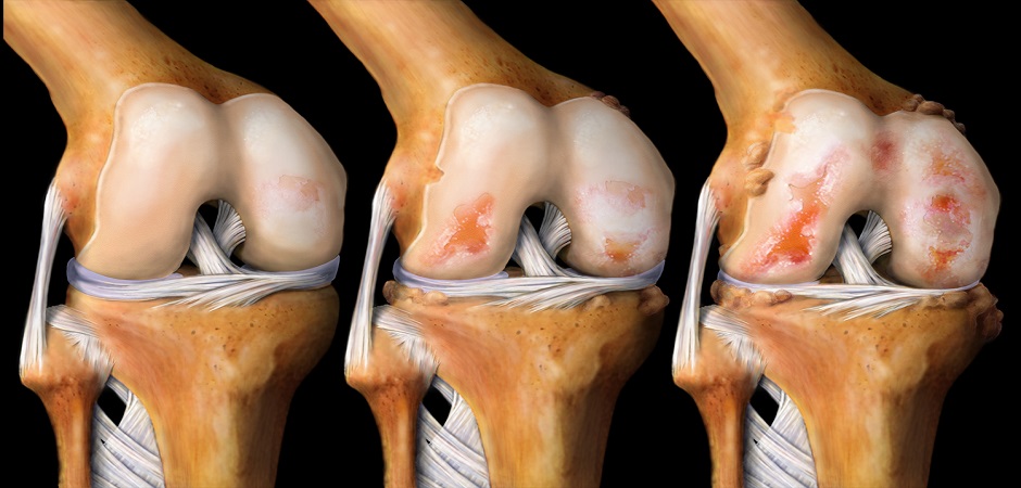 Лечение артроза коленного сустава 3 степени